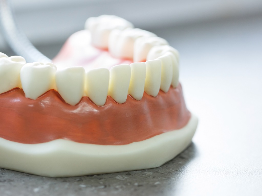 Quelles solutions en cas de perte de dents ?
