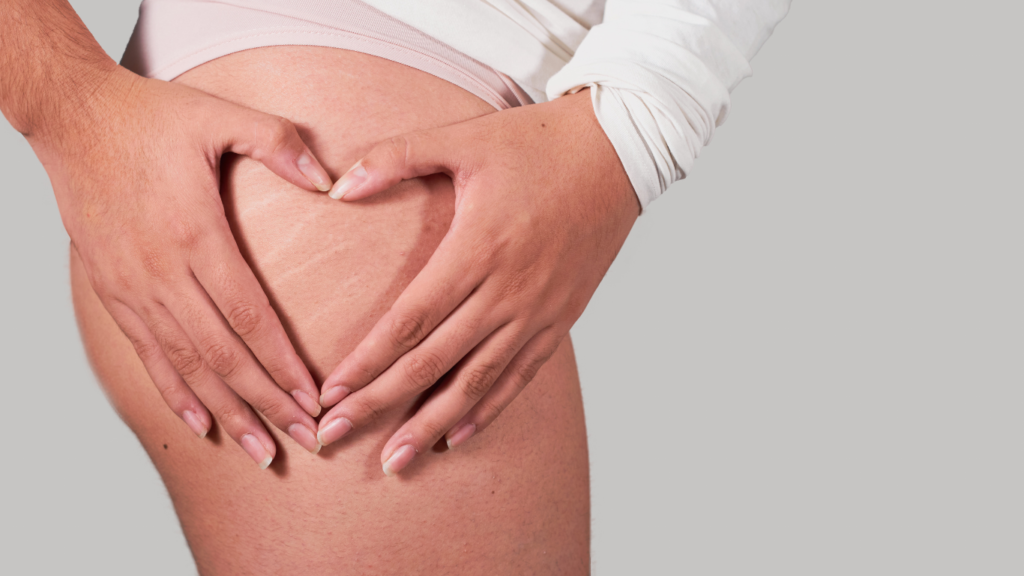 Comment Se Débarrasser de la Cellulite : Solutions Efficaces et Conseils Clés